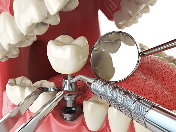 Best Emergency Tooth Extraction in Forney, TX